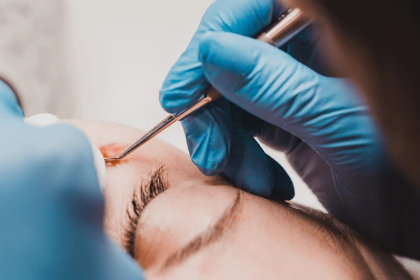 Milia removal at Vivardi Clinics Rawang