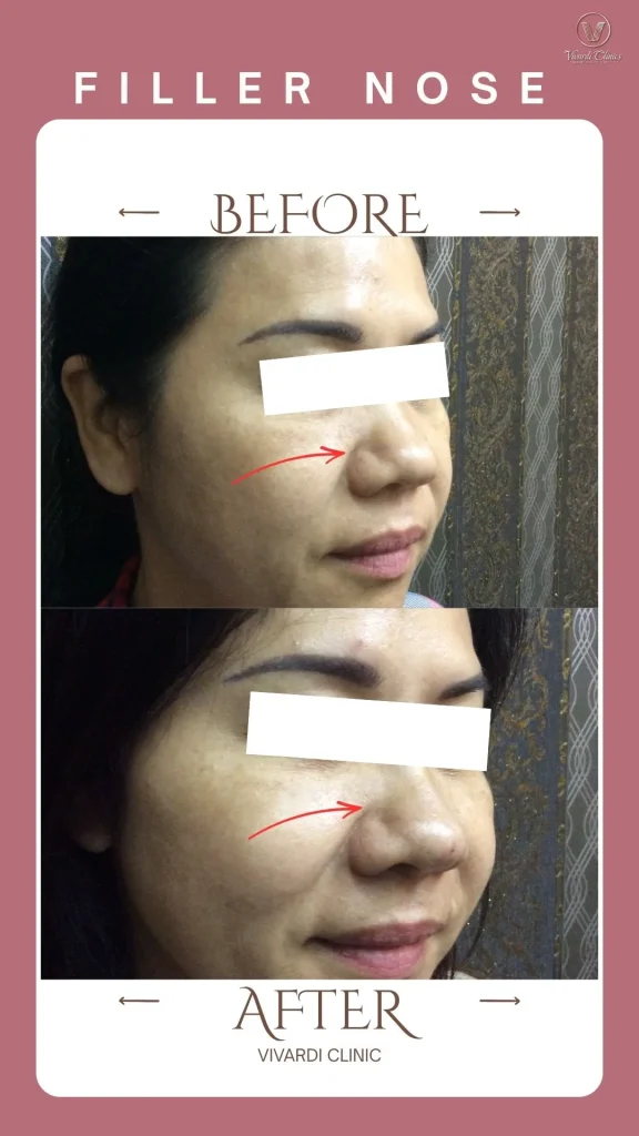 Before and after non-surgical nose filler at Vivardi Clinics Rawang