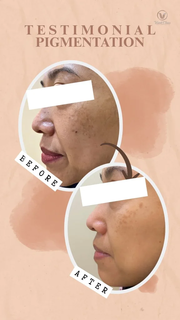 Before and after pigmentation treatment at Vivardi Clinics Rawang