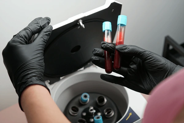 Platelet rich plasma prp treatment preparation 600nw