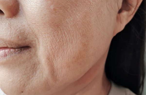 Portrait showing flabbiness adipose hanging beside 600nw