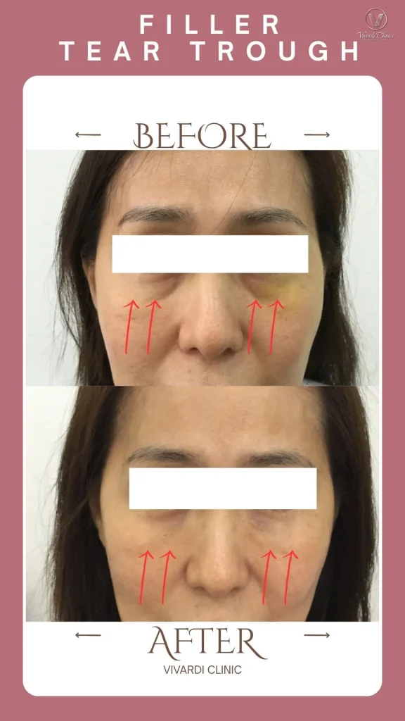 Before and after tear trough (under-eye) filler at Vivardi Clinics Rawang
