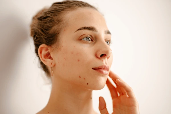 Acne Therapy